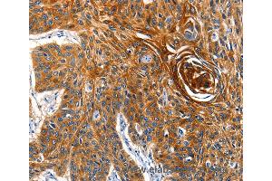 Immunohistochemistry of Human esophagus cancer using AQP5 Polyclonal Antibody at dilution of 1:40 (Aquaporin 5 抗体)