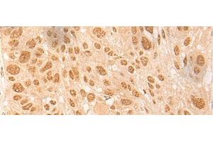 Immunohistochemistry of paraffin-embedded Human esophagus cancer tissue using DBP Polyclonal Antibody at dilution of 1:25(x200) (DBP 抗体)