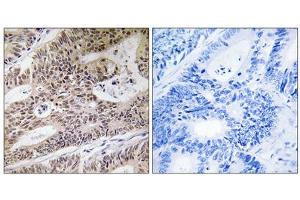 Immunohistochemistry analysis of paraffin-embedded human colon carcinoma tissue using NPHP4 antibody. (NPHP4 抗体  (Internal Region))