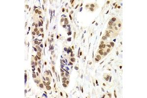 Immunohistochemistry of paraffin-embedded human breast cancer using NASP Antibody. (NASP 抗体)