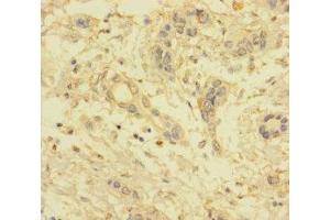 Immunohistochemistry of paraffin-embedded human pancreatic cancer using ABIN7175533 at dilution of 1:100 (VKORC1L1 抗体  (AA 38-91))