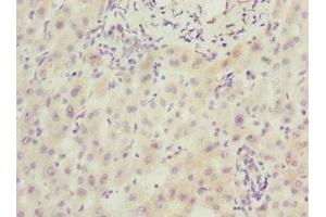 Immunohistochemistry of paraffin-embedded human liver cancer using ABIN7168604 at dilution of 1:100 (SCAND1 抗体  (AA 1-179))