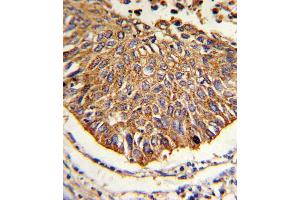 Formalin-fixed and paraffin-embedded human lung carcinoma reacted with MDH2 Antibody , which was peroxidase-conjugated to the secondary antibody, followed by DAB staining. (MDH2 抗体  (AA 86-115))