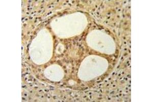 Immunohistochemistry analysis in prostate carcinoma (Formalin-fixed, Paraffin-embedded) using PRUNE  Antibody (C-term), followed by peroxidase conjugation of the secondary antibody and DAB staining. (PRUNE 抗体  (C-Term))