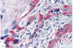 Human Placenta (formalin-fixed, paraffin-embedded) stained with TGM2 antibody ABIN337398 at 5 ug/ml followed by biotinylated goat anti-rabbit IgG secondary antibody ABIN481713, alkaline phosphatase-streptavidin and chromogen. (Transglutaminase 2 抗体)