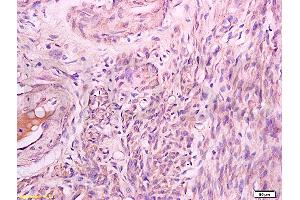 Formalin-fixed and paraffin embedded human lung carcinoma labeled with Rabbit Anti Phospho-Talin (Ser425) Polyclonal Antibody, Unconjugated (ABIN703135) at 1:200 followed by conjugation to the secondary antibody and DAB staining (Talin 抗体  (pSer425))