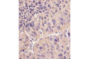 B staining hFACL4 in human human hepatocarcinoma sections by Immunohistochemistry (IHC-P - paraformaldehyde-fixed, paraffin-embedded sections). (ACSL4 抗体  (AA 236-267))