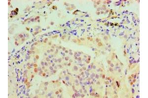 Immunohistochemical of paraffin-embedded Human lung cancer tissue using ABIN7160272 at dilution of 1:200.