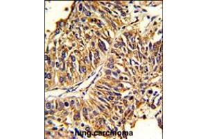 Formalin-fixed and paraffin-embedded human lung carcinoma reacted with HMGCS1 Antibody , which was peroxidase-conjugated to the secondary antibody, followed by DAB staining. (HMGCS1 抗体  (AA 290-317))
