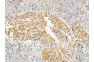 ABIN6265850 and ABIN6278111 at 1/100 staining human lung squamous cell carcinoma by IHC-P.