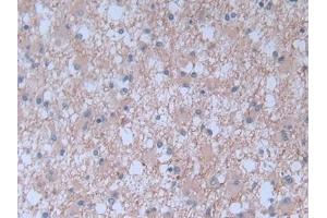 Detection of BNP in Human Glioma Tissue using Monoclonal Antibody to Brain Natriuretic Peptide (BNP) (BNP 抗体)