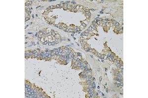 Immunohistochemistry of paraffin-embedded human prostate using ALDH3A1 Antibody (ABIN6290003) at dilution of 1:100 (40x lens). (ALDH3A1 抗体)