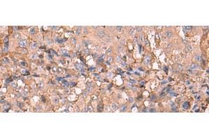Immunohistochemistry of paraffin-embedded Human liver cancer tissue using NOTCH4 Polyclonal Antibody at dilution of 1:30(x200) (NOTCH4 抗体)