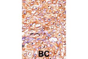 Formalin-fixed and paraffin-embedded human breast cancer tissue reacted with DUSP10 polyclonal antibody  , which was peroxidase-conjugated to the secondary antibody, followed by AEC staining. (DUSP10 抗体  (N-Term))
