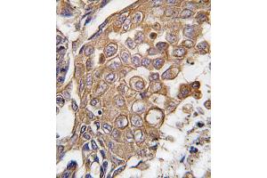 Formalin-fixed and paraffin-embedded human lung carcinoma tissue reacted with ALOX5 antibody (Center), which was peroxidase-conjugated to the secondary antibody, followed by DAB staining. (ALOX5AP 抗体  (AA 86-117))