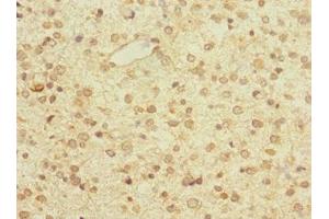 Immunohistochemistry of paraffin-embedded human glioma using ABIN7176525 at dilution of 1:100 (ZNF774 抗体  (AA 101-300))