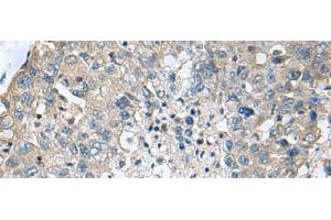 Immunohistochemistry of paraffin-embedded Human liver cancer tissue using TGM3 Polyclonal Antibody at dilution of 1:55(x200) (TGM3 抗体)