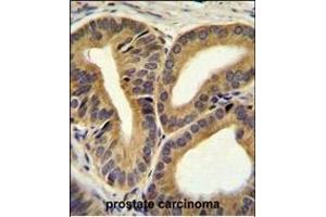 TRIM65 Antibody (Center) (ABIN655759 and ABIN2845202) immunohistochemistry analysis in formalin fixed and paraffin embedded human prostate carcinoma followed by peroxidase conjugation of the secondary antibody and DAB staining. (TRIM65 抗体  (AA 327-355))