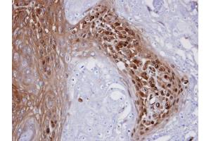 IHC-P Image Immunohistochemical analysis of paraffin-embedded CA922 xenograft, using WBSCR22 , antibody at 1:100 dilution. (WBSCR22 抗体  (Center))