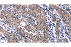 Immunohistochemistry of paraffin-embedded Human gasrtic cancer tissue using ESPL1 Polyclonal Antibody at dilution 1:40 (Separase 抗体)