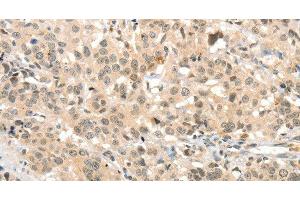 Immunohistochemistry of paraffin-embedded Human esophagus cancer tissue using TSPYL2 Polyclonal Antibody at dilution 1:30 (TSPY-Like 2 抗体)