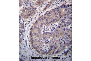 PNLIPRP3 Antibody (N-term) (ABIN656711 and ABIN2845941) immunohistochemistry analysis in formalin fixed and paraffin embedded human hepatocarcinoma followed by peroxidase conjugation of the secondary antibody and DAB staining. (PNLIPRP3 抗体  (N-Term))