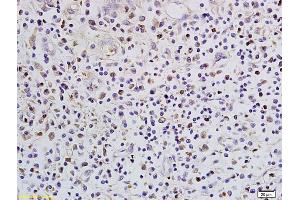 Formalin-fixed and paraffin embedded human colon cancer labeled with Anti-SATB1 Polyclonal Antibody, Unconjugated (ABIN732008) followed by conjugation to the secondary antibody and DAB staining (SATB1 抗体  (AA 671-764))