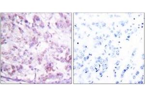 Immunohistochemistry analysis of paraffin-embedded human breast carcinoma tissue, using MYB (Ab-12) Antibody. (MYB 抗体  (AA 1-50))