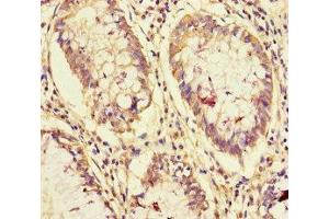 Immunohistochemistry of paraffin-embedded human colon cancer using ABIN7161865 at dilution of 1:100 (NCOA6 抗体  (AA 285-504))