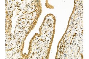 ABIN6259925 and ABIN6268670 at 1/100 staining Human ovarian cancer and adjacent normal tissues by IHC-P.