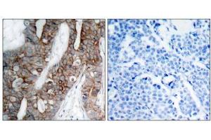 Immunohistochemical analysis of paraffin-embedded human breast carcinoma tissue using Integrin β3 (Ab-773) antibody (E021082). (Integrin beta 3 抗体)