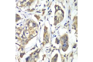 Immunohistochemistry of paraffin-embedded human liver cancer using NFS1 antibody at dilution of 1:100 (x40 lens). (NFS1 抗体)