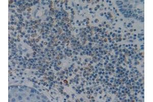 IHC-P analysis of Human Skin cancer Tissue, with DAB staining. (Fibrillin 1 抗体  (AA 723-902))