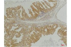 Immunohistochemistry (IHC) analysis of paraffin-embedded Human Breast Carcinoma using CXCR4 Rabbit Polyclonal Antibody diluted at 1:200. (CXCR4 抗体)