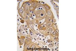 Formalin-fixed and paraffin-embedded human lung carcinoma tissue reacted with PTRF antibody (N-term) (ABIN391621 and ABIN2841540) , which was peroxidase-conjugated to the secondary antibody, followed by DAB staining. (PTRF 抗体  (N-Term))