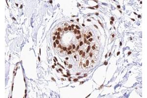 ABIN6267488 at 1/100 staining human Breast carcinoma tissue sections by IHC-P. (DDIT3 抗体  (pSer30))