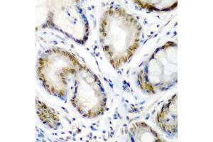 Immunohistochemistry of paraffin-embedded human colon carcinoma using SS18 antibody (ABIN5975075) at dilution of 1/200 (40x lens). (SS18 抗体)