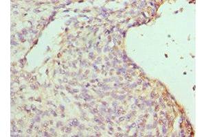 Immunohistochemistry of paraffin-embedded human endometrial cancer using ABIN7155457 at dilution of 1:100 (RBBP7 抗体  (AA 1-230))