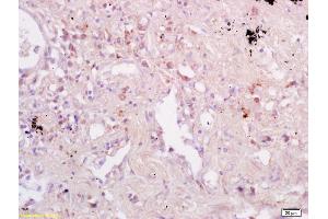 Formalin-fixed and paraffin embedded human kidney labeled with Anti-CD74/MHC II Polyclonal Antibody, Unconjugated (ABIN741435) at 1:200 followed by conjugation to the secondary antibody and DAB staining.