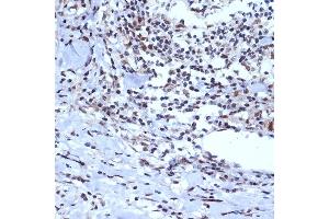 Immunohistochemistry of paraffin-embedded human esophageal cancer using A Rabbit mAb (ABIN7265387) at dilution of 1:100 (40x lens). (BAF53A 抗体)