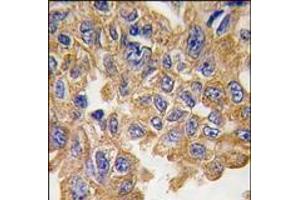 Formalin-fixed and paraffin-embedded human lung carcinoma tissue reacted with AKT2 Antibody, which was peroxidase-conjugated to the secondary antibody, followed by DAB staining.