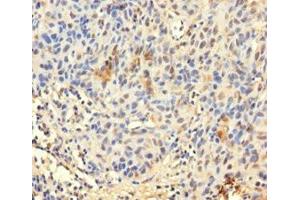 Immunohistochemistry of paraffin-embedded human bladder cancer using ABIN7172423 at dilution of 1:100 (TCEANC2 抗体  (N-Term))