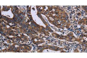Immunohistochemistry of paraffin-embedded Human gastic cancer using LZTFL1 Polyclonal Antibody at dilution of 1:50 (LZTFL1 抗体)