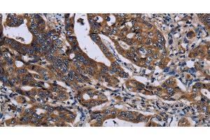 Immunohistochemistry of paraffin-embedded Human gastic cancer using LZTFL1 Polyclonal Antibody at dilution of 1:50