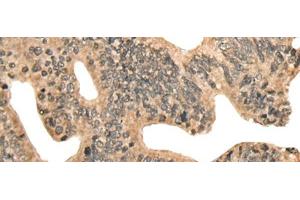 Immunohistochemistry of paraffin-embedded Human colorectal cancer tissue using CCNB1IP1 Polyclonal Antibody at dilution of 1:30(x200) (CCNB1IP1 抗体)