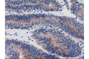 Immunohistochemical staining of paraffin-embedded Adenocarcinoma of Human endometrium tissue using anti-BIN3 mouse monoclonal antibody. (BIN3 抗体)