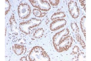 Formalin-fixed, paraffin-embedded human Prostate Carcinoma stained with ATRX Rabbit Recombinant Monoclonal Antibody (ATRX/2900R). (Recombinant ATRX 抗体)