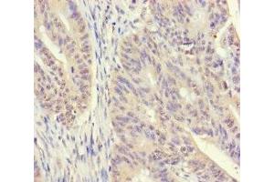 Immunohistochemistry of paraffin-embedded human colon cancer using ABIN7170541 at dilution of 1:100 (Spermidine Synthase 抗体  (AA 17-302))