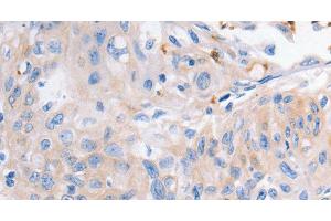 Immunohistochemistry of paraffin-embedded Human cervical cancer using KCNA1 Polyclonal Antibody at dilution of 1:30 (KCNA1 抗体)