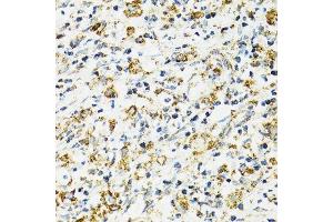 Immunohistochemistry of paraffin-embedded human uterine cancer using HSPA9 antibody. (HSPA9 抗体  (AA 380-679))